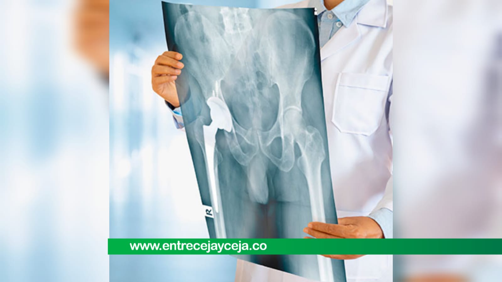 Martes de Salud; osteoporosis y como prevenirla