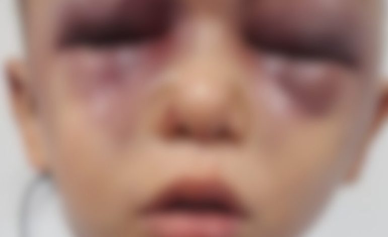 Niño de 3 años padeció brutal golpiza a manos de su padrastro