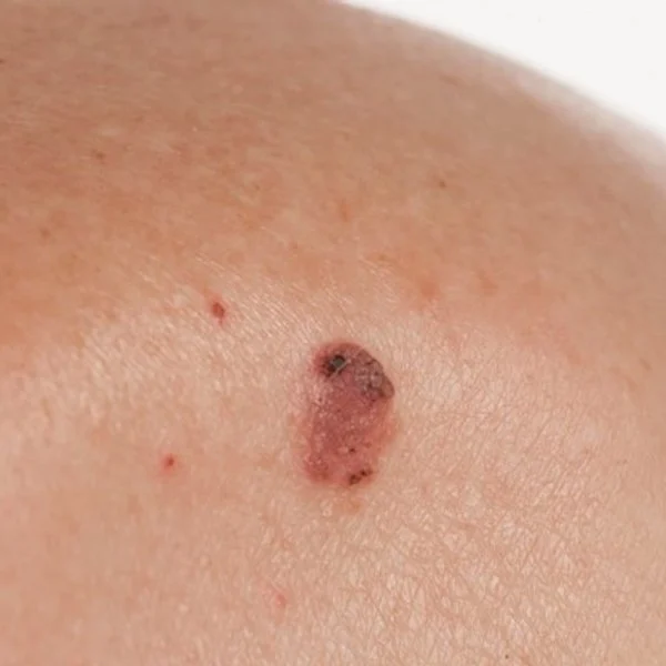 ¿Cómo saber si un lunar es cancerígeno? Claves para detectar un melanoma
